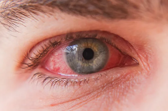 uveitis, red eye, blurry vision, eye pain, light sensativity