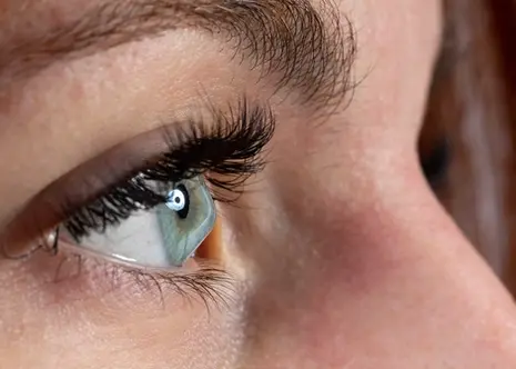 Keratoconus